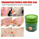 Fezema Graffi Eczema Cream – 20g Psoriasis & Dermatitis Treatment – Chinese Herbal Anti-Itch Ointment for Cracked, Scaly Skin Repair
