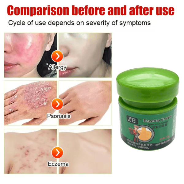 Fezema Graffi Eczema Cream – 20g Psoriasis & Dermatitis Treatment – Chinese Herbal Anti-Itch Ointment for Cracked, Scaly Skin Repair